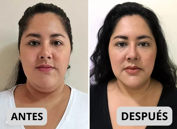 Faja Reductora De Papada